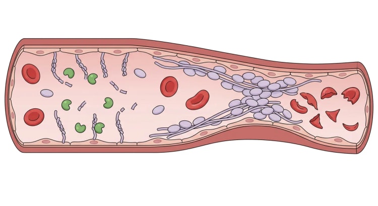 Längsschnitt einer Arteriole. Links werden kurze Von-Willebrand-Faktor-Stränge durch ADAMTS13 gespalten, rechts bilden lange ungespaltene Stränge mit gebundenen Thrombozyten einen Mikrothrombus, und stromabwärts sind fragmentierte Erythrozyten zu sehen.