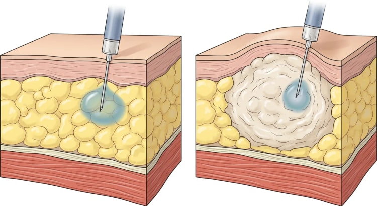 Zwei Querschnitte der Bauchwand mit Haut, subkutanem Fettgewebe und Muskel. Links liegt das Insulindepot in normalem subkutanem Fettgewebe und rechts in einem lipohypertrophen Knoten.