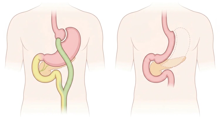 Schematische Anatomie nach Roux-en-Y-Magenbypass links und Sleeve-Gastrektomie rechts, Ansicht von vorn.