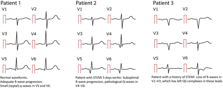 Figure 12. Normal and pathological Q-waves.
