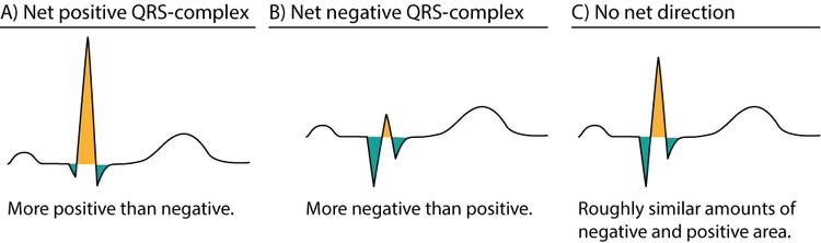 Figure 6. Approximations of the net direction of the QRS-complex. The positive areas are yellow and the negative areas are green.