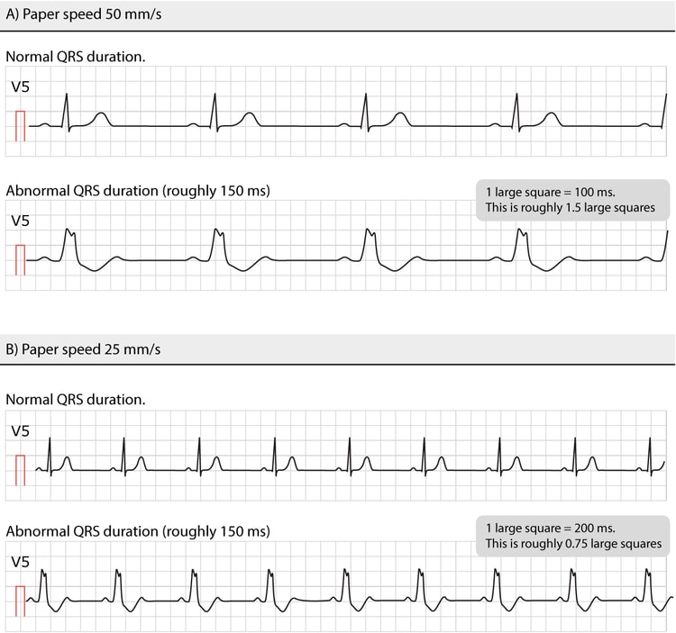 Figure 8. Normal and abnormal QRS durations at different paper speeds.