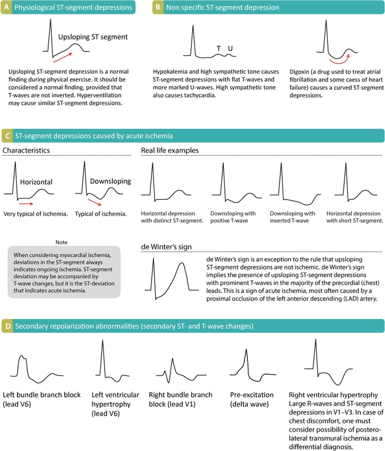 Figure 15. Various causes of ST segment depressions and their appearance.