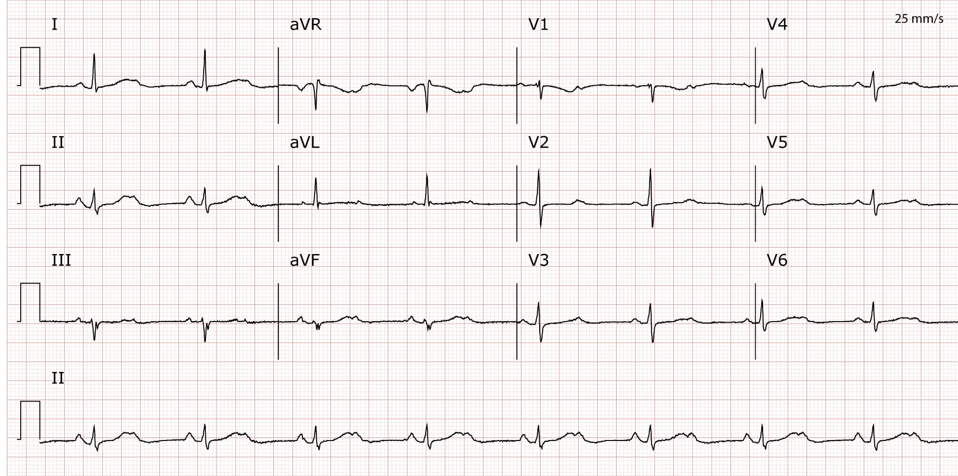 Illustration ur kursen Ventrikuläre Arrhythmien und plötzlicher Herztod - 2