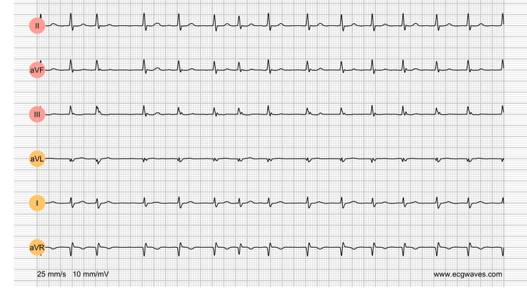 EKG-Testbibliothek: Frage 2