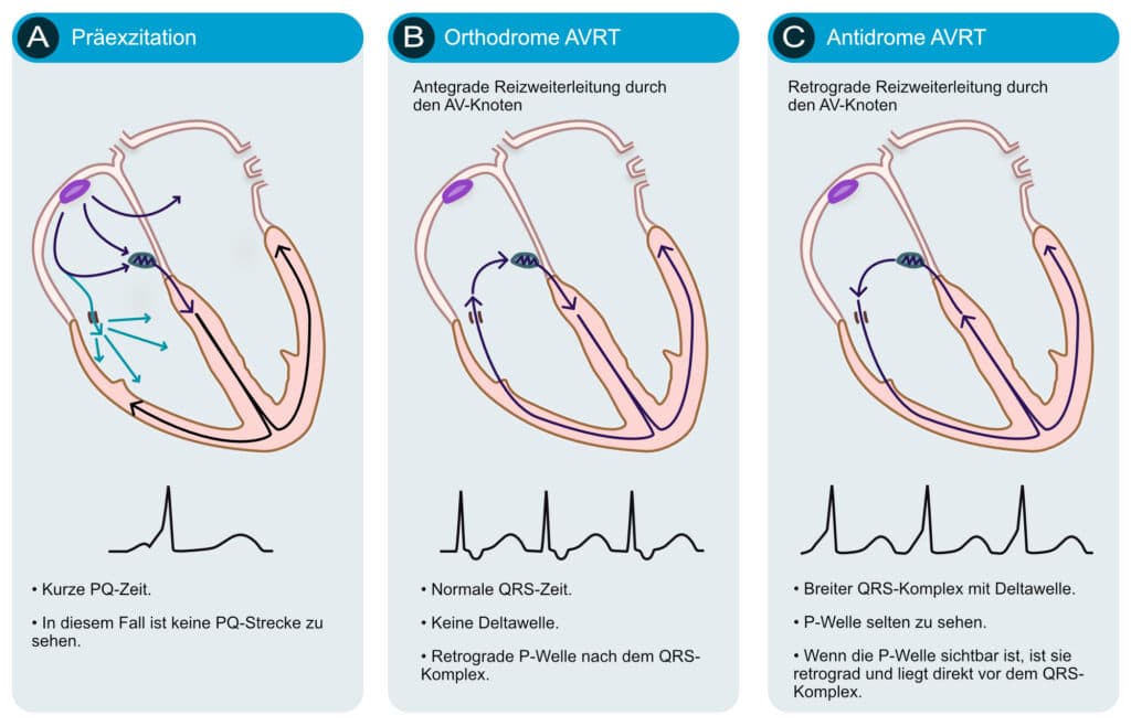 Illustration ur kursen EKG-Test 9