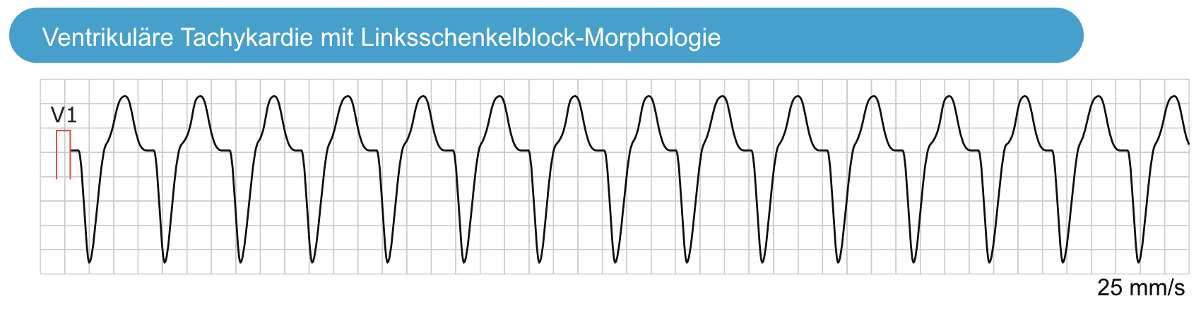 Illustration ur kursen Vorhofflimmern, Vorhofflattern und ektope atriale Rhythmen