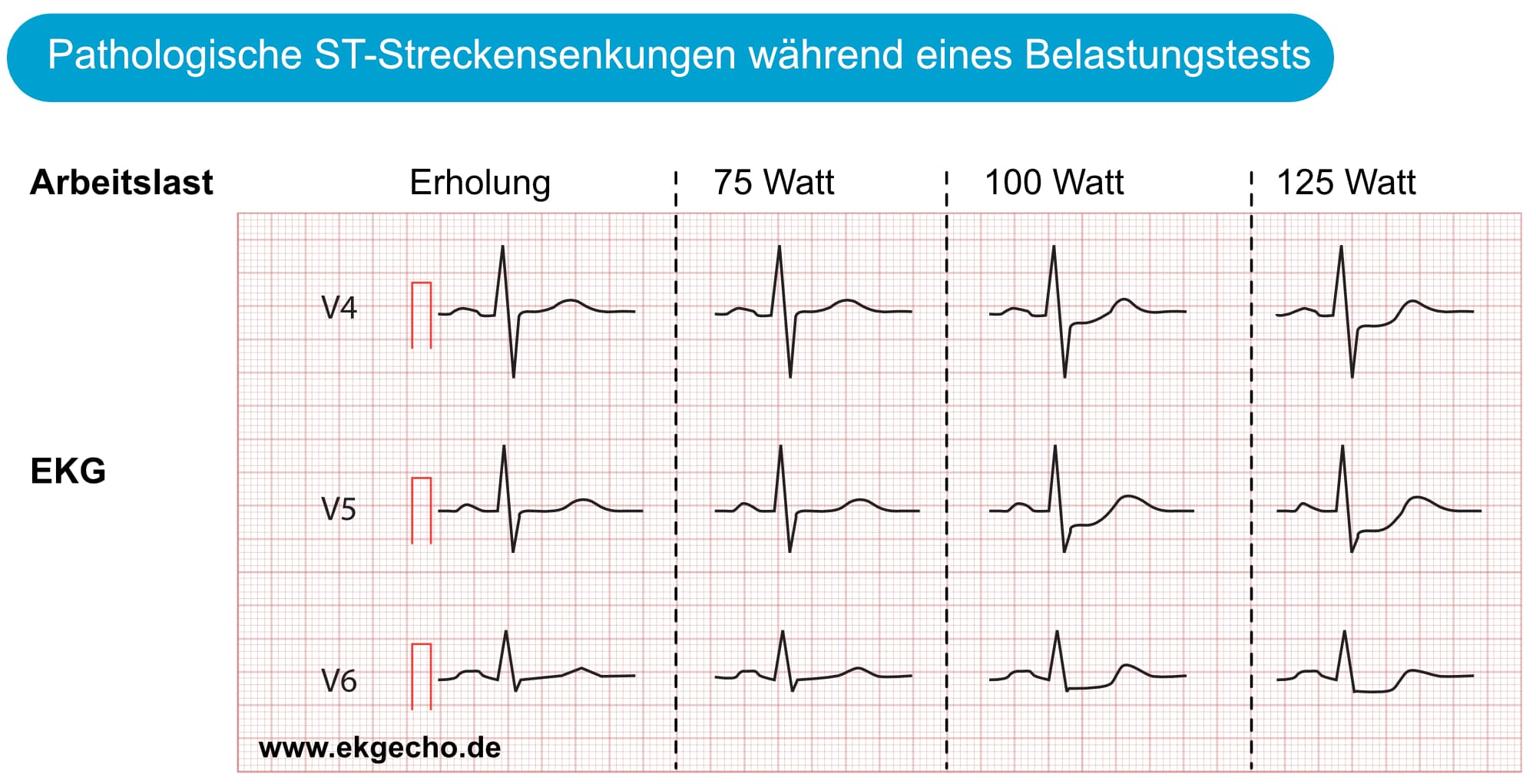Illustration ur kursen EKG Übungstest 2