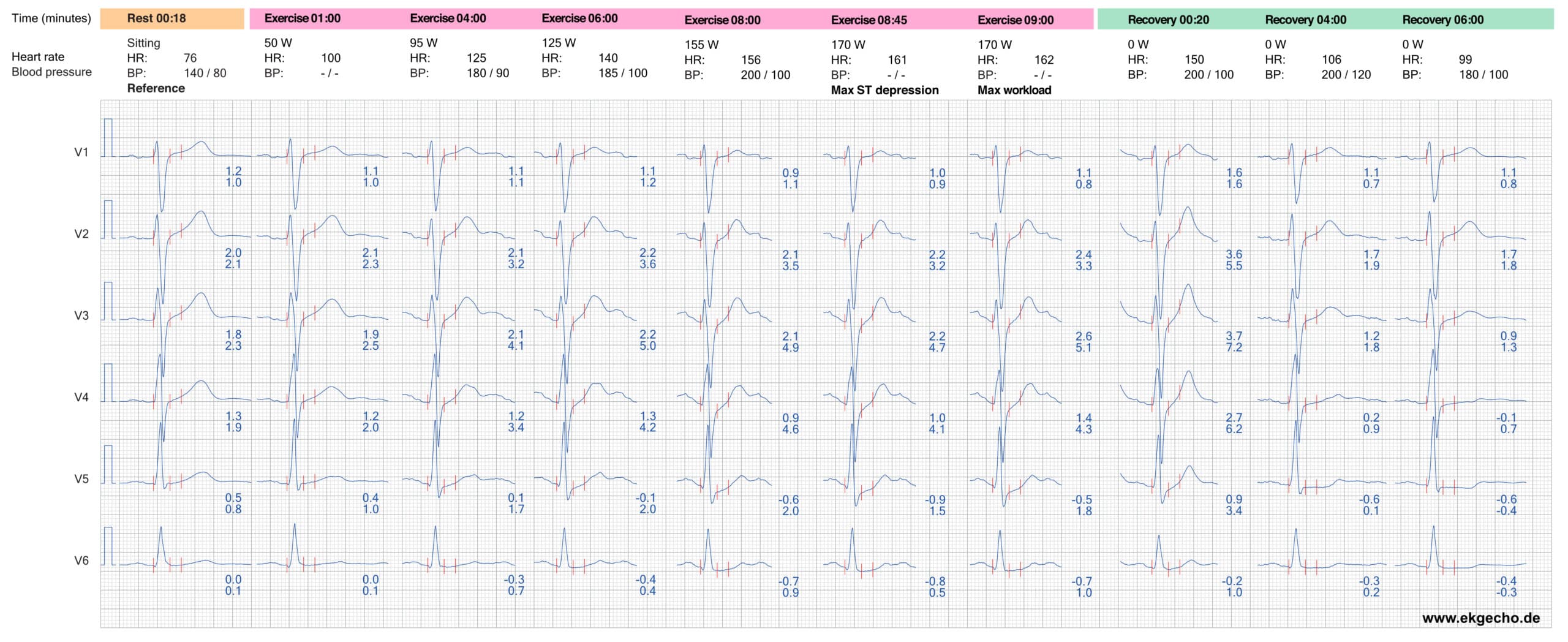 Illustration ur kursen Ischämische Herzkrankheit (chronische Koronarsyndrome)