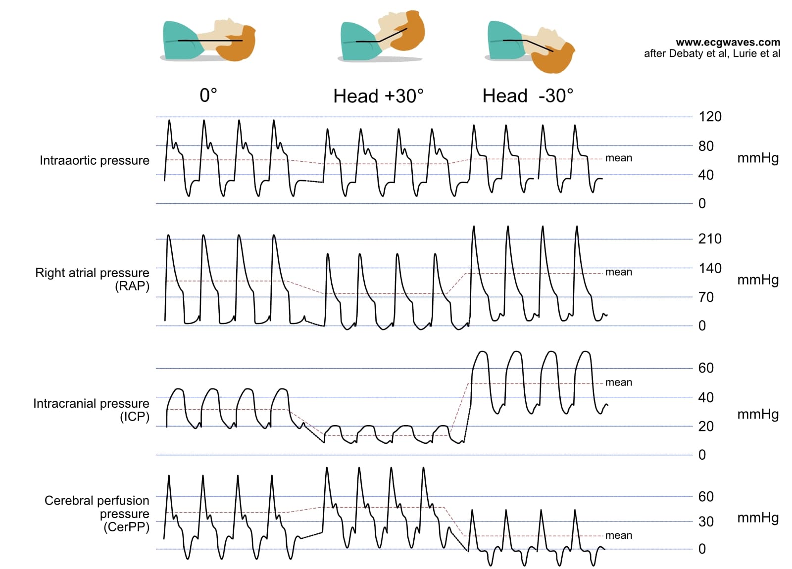Illustration aus dem Kurs Plötzlicher Herzstillstand und kardiopulmonale Reanimation (CPR)