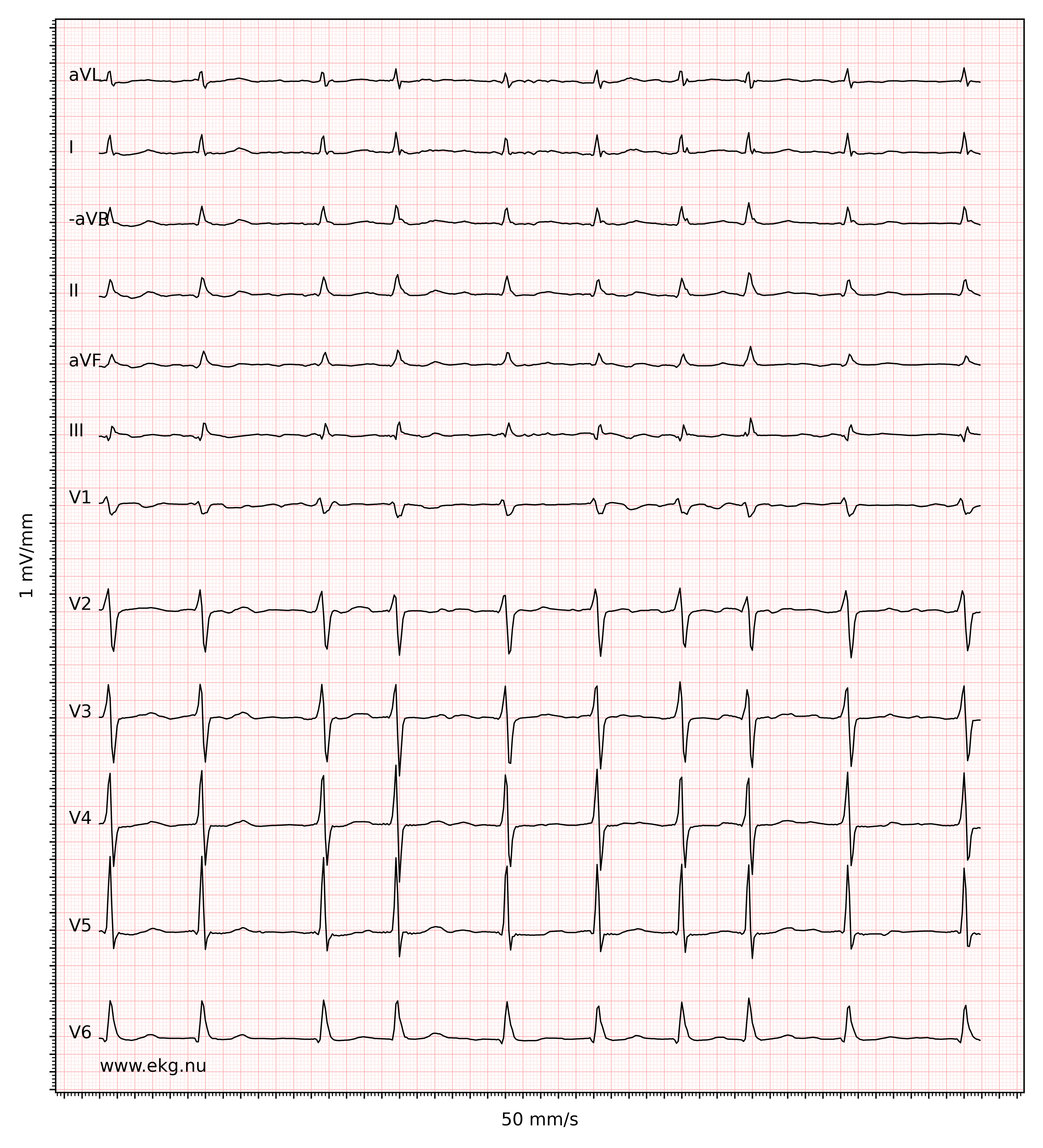 Illustration ur kursen EKG-Test 3