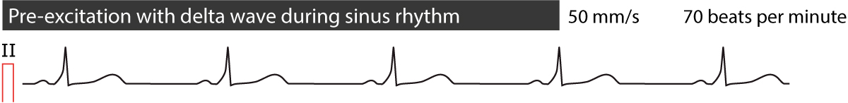 Abbildung 5. Präexzitation bei Sinusrhythmus.