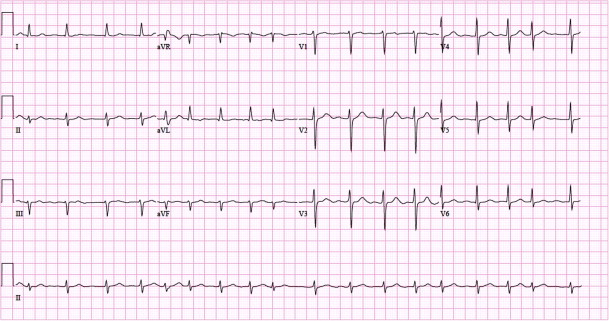 Abbildung 5. Beispiel eines 12-Kanal-EKGs mit Vorhofflimmern. Papiergeschwindigkeit: 25 mm/s.