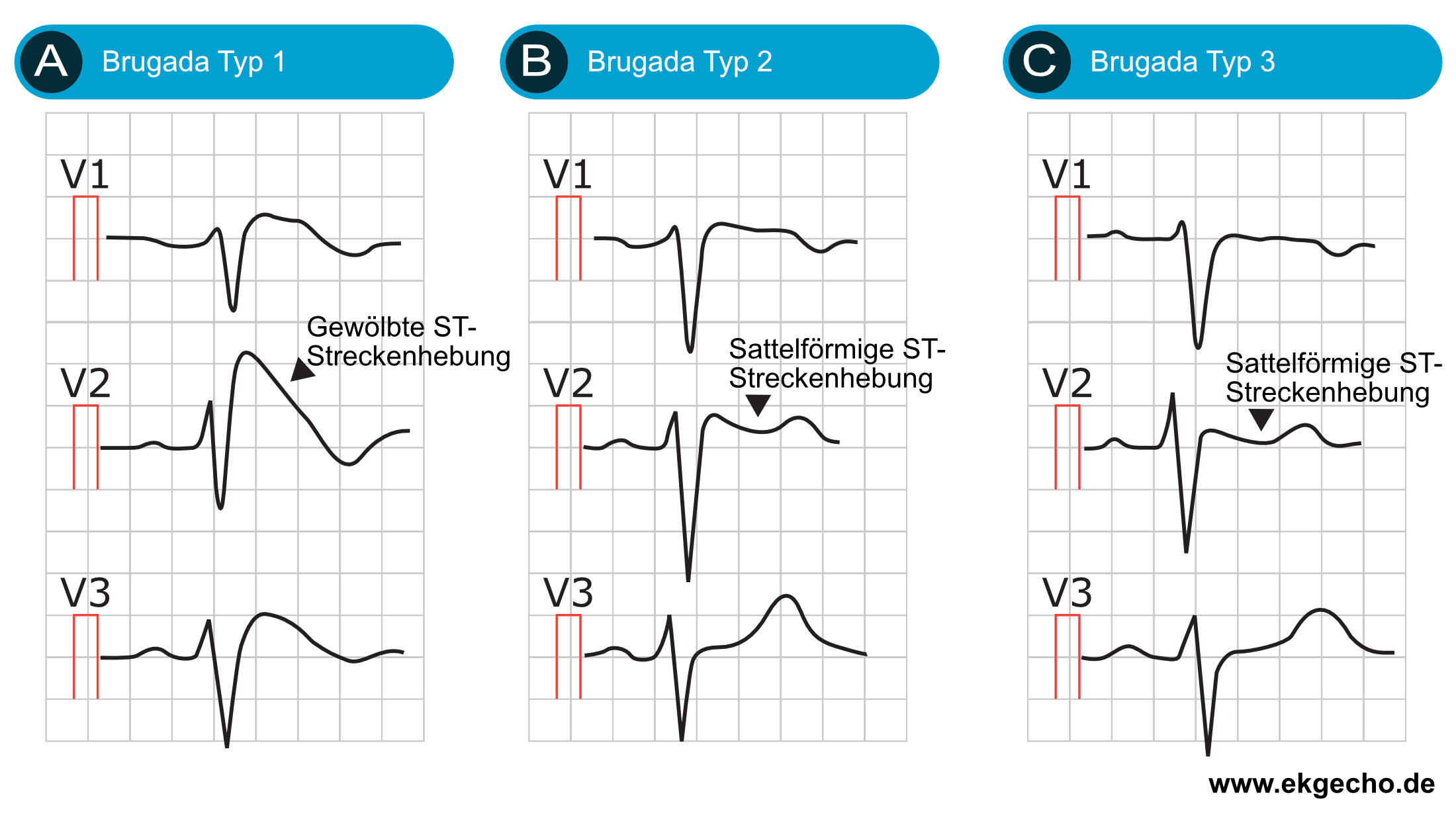 Abbildung 10. Brugada-Syndrom Typ 1, Typ 2 und Typ 3.
