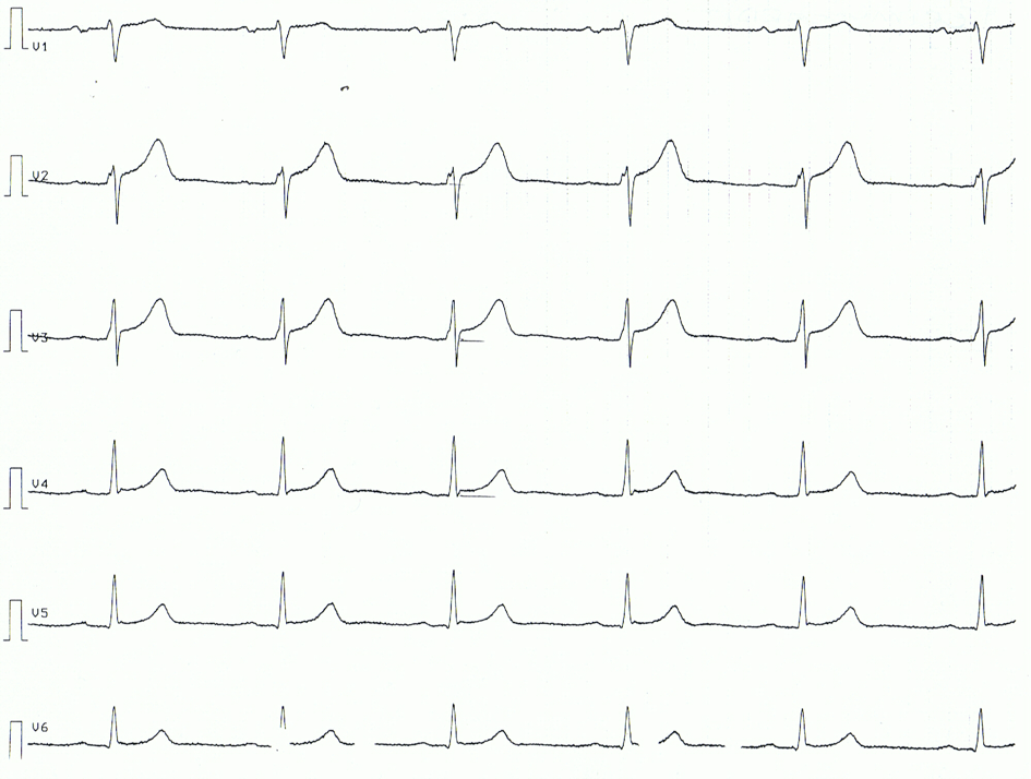 Abbildung 3. Brustwandableitungen eines Patienten mit akuter Perikarditis. Zu beachten sind die ST-Strecken-Hebungen und die konkaven ST-Strecken.