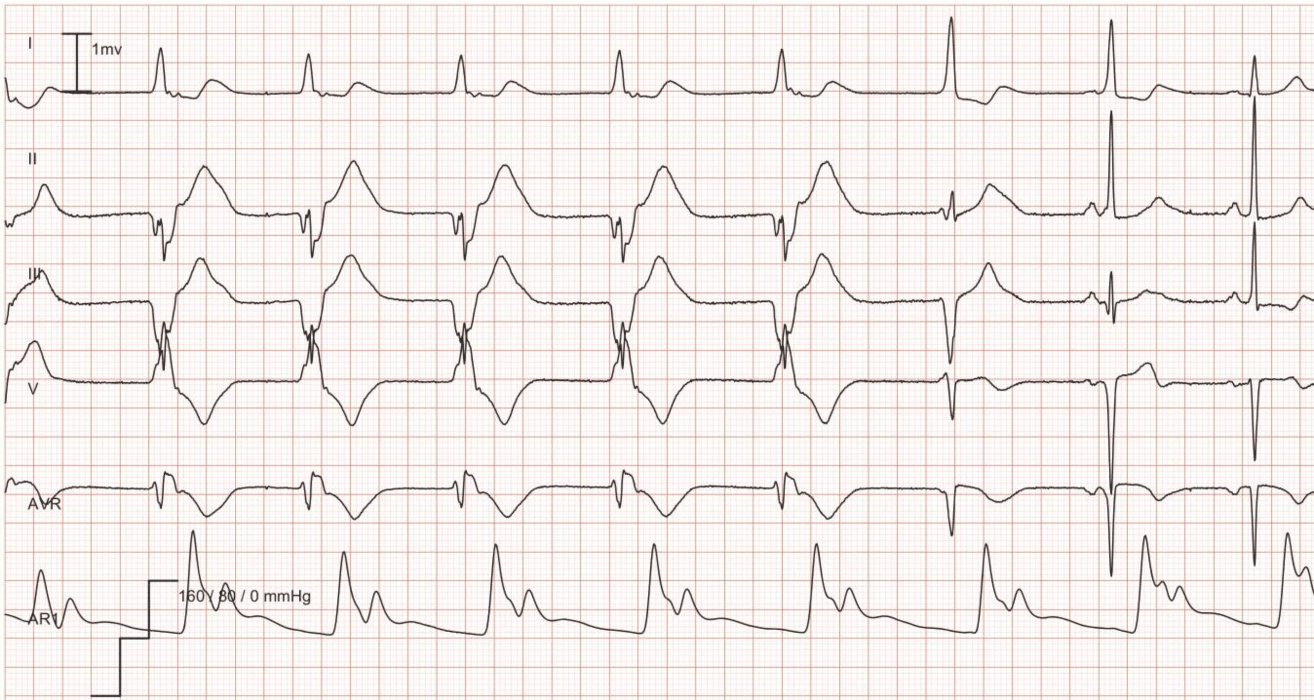 EKG-Beispiel: Idioventrikulärer Rhythmus (akzelerierter ventrikulärer Rhythmus): akzelerierter ventrikulärer Rhythmus mit einer Frequenz von 56 während der ersten 5 Schläge, gefolgt von 2 Fusionsschlägen; die letzten 2 Schläge zeigen einen normalen Sinusrhythmus.