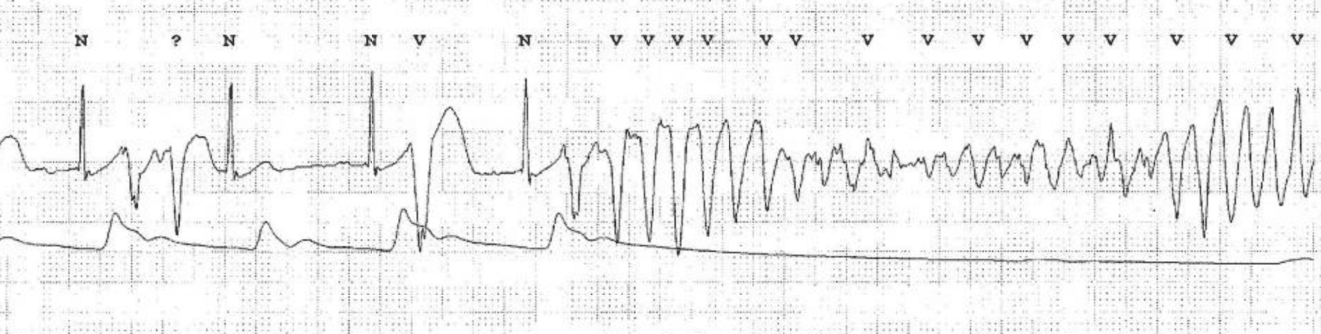 EKG mit einer Episode von Sinusrhythmus (mit mehreren ventrikulären Extrasystolen), die spontan in eine ventrikuläre Torsade-de-Pointes-Tachykardie übergeht. Der arterielle Blutdruck (ABP) fällt mit Beginn der TdP ab. EKG von Nakstad et al (Scand J Trauma Resusc Emerg Med. 2010; 18: 7)