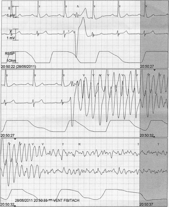 EKG mit ventrikulärer Tachykardie, die in Kammerflimmern übergeht. Nach Bagnall et al: BMC Medical Genetics 15 (2014): 99.