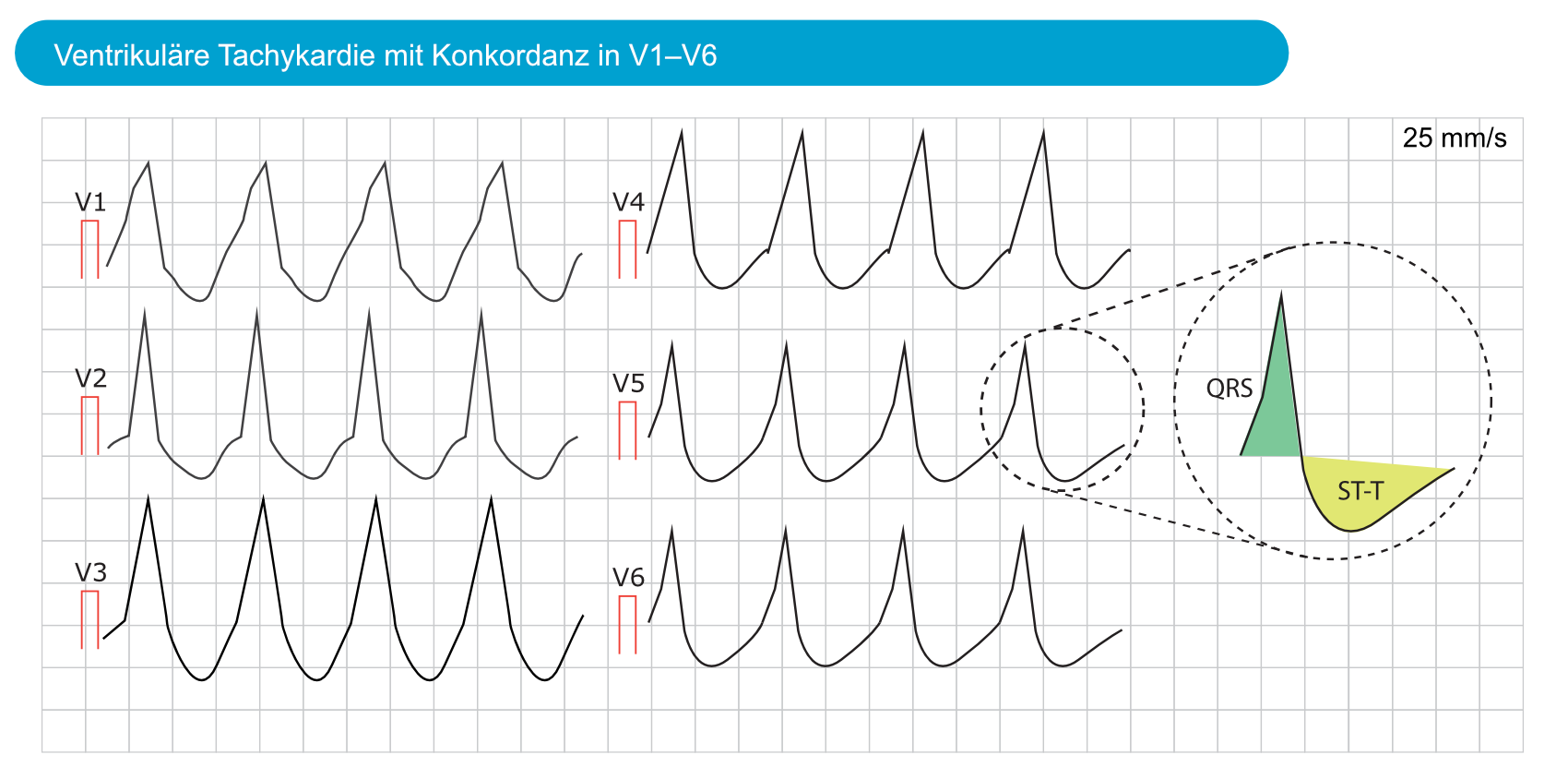 Abbildung 7. Konkordanz in QRS-Komplexen von V1 bis V6 bei ventrikulärer Tachykardie.