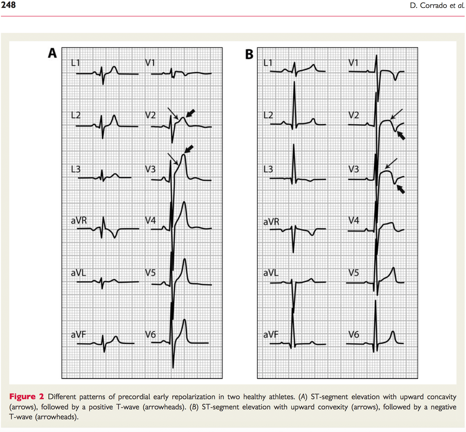 EKG aus der Arbeit zur EKG-Interpretation bei Sportlern (Screenshot 2016-11-17, 21-15-29)