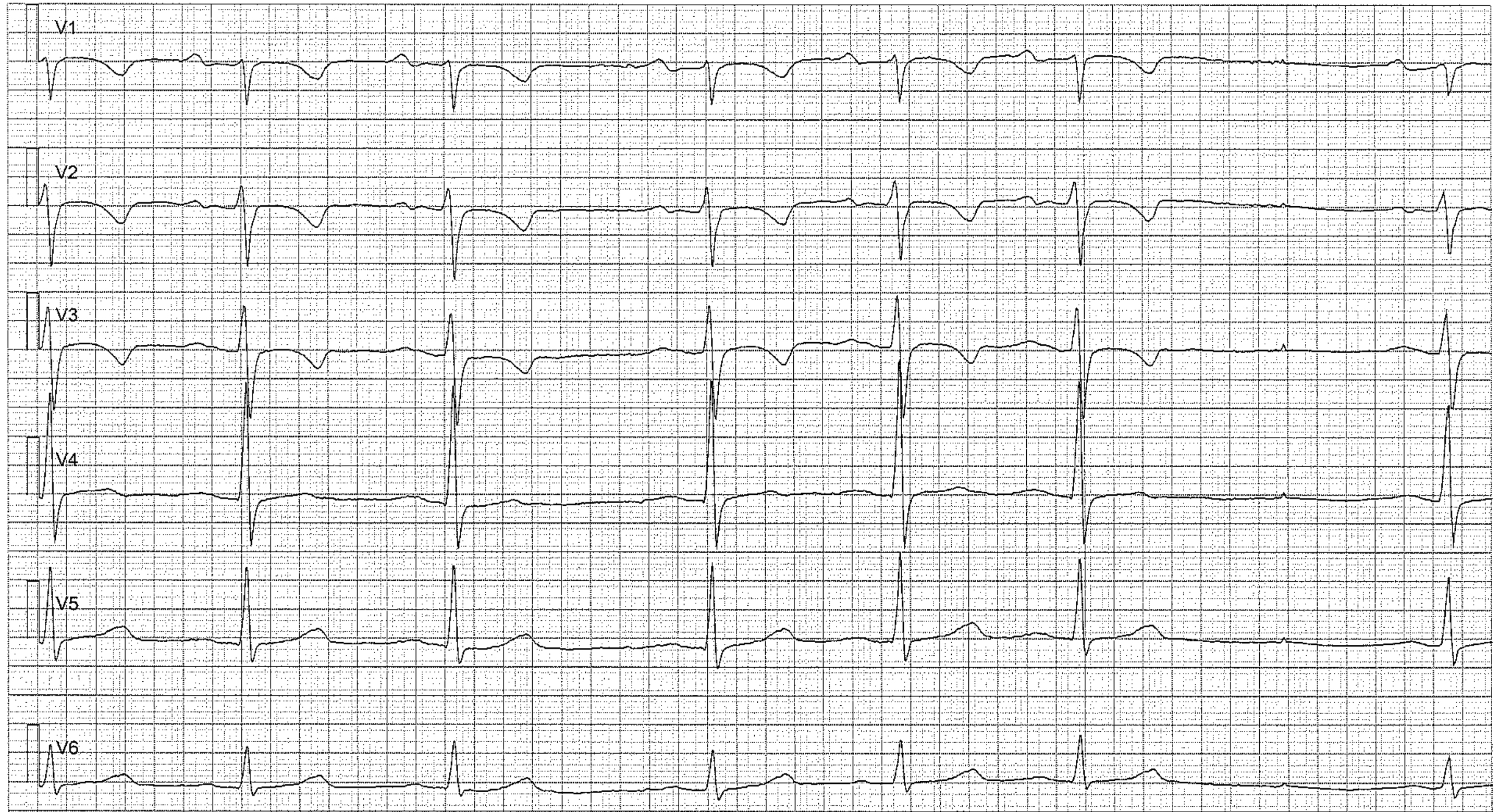 Abbildung 4. Sinusarrhythmie mit Sinuspause. Negative T-Wellen sind in V1–V3 normal (der Patient war bei der EKG-Aufzeichnung 15 Jahre alt).