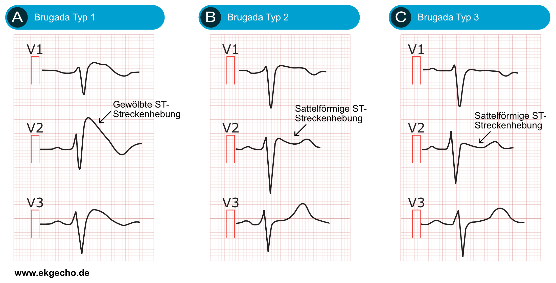 Abbildung 1. Brugada-Syndrom Typ 1, Typ 2, Typ 3.