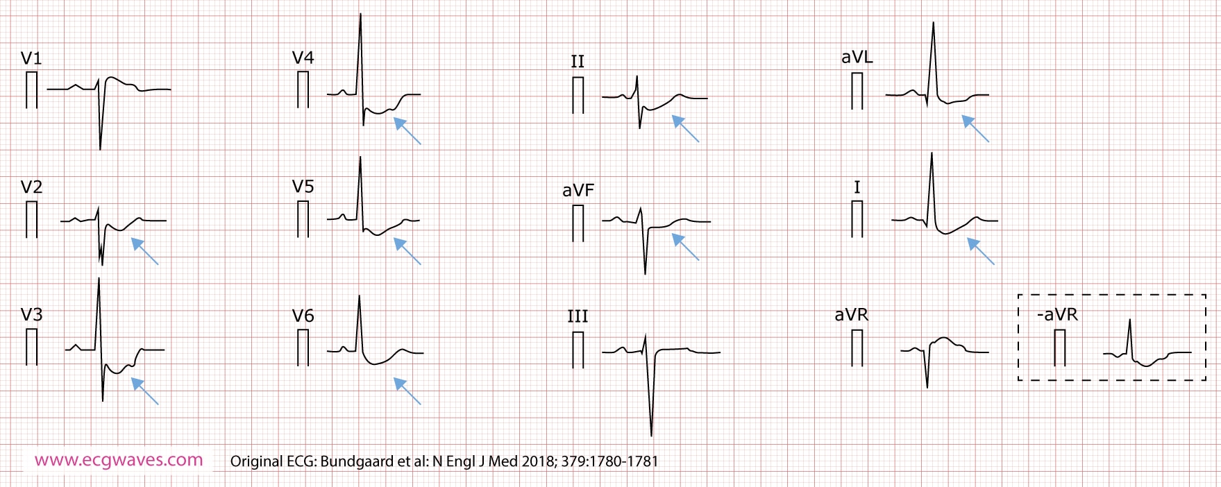 Abbildung 4. Das im Alter von 63 Jahren aufgezeichnete 12-Kanal-EKG (nach Cabrera dargestellt) zeigt nach oben konkave ST-Strecken-Senkungen in den Ableitungen I, II, aVL, aVF und V2 bis V6 sowie eine ST-Strecken-Hebung in aVR (entsprechend einer identischen ST-Strecken-Senkung in der invertierten Ableitung -aVR). Im ansteigenden Teil der ST-Strecke ist eine Kerbe erkennbar.