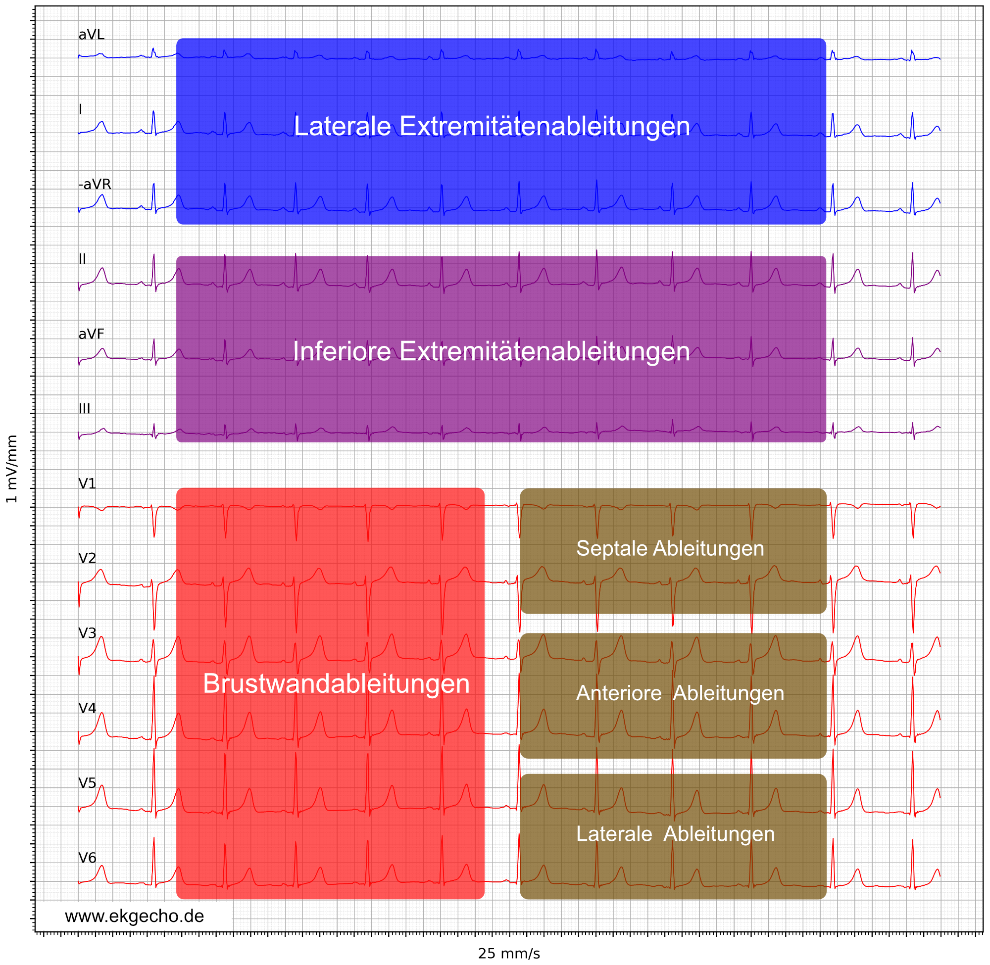 Abbildung 3. Präsentation des EKG-Ableitungen im Cabrera-Format, aVR wurde invertiert zu –aVR.