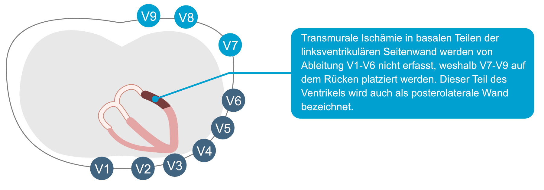 Abbildung 23. Posteriore Brustwandableitungen können einen  posterioren ST-Strecken-Hebungs-Infarkt zeigen. Diese Ableitungen sollten zusätzlich platziert werden, wenn das EKG einen Hinweis auf posterolaterale Ischämie zeigt.