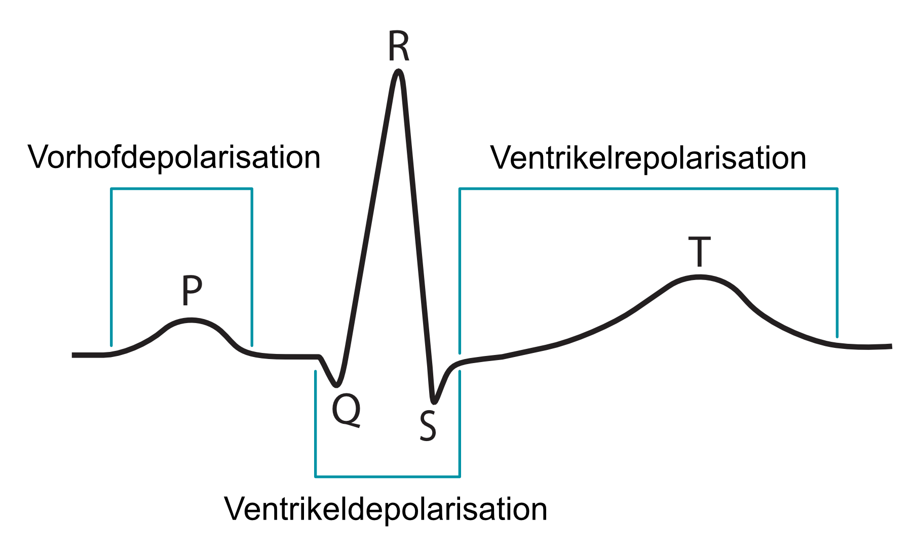 Abbildung 4. Die klassische EKG-Kurve und die sich darin widerspiegelnden Ereignisse. Die obige EKG-Kurve zeigt einen QRS-Komplex, der aus Q-, R- und S-Zacke besteht. Selbst wenn eine oder zwei der Zacken im QRS-Komplex fehlten, würde dies dennoch als QRS-Komplex bezeichnet werden.