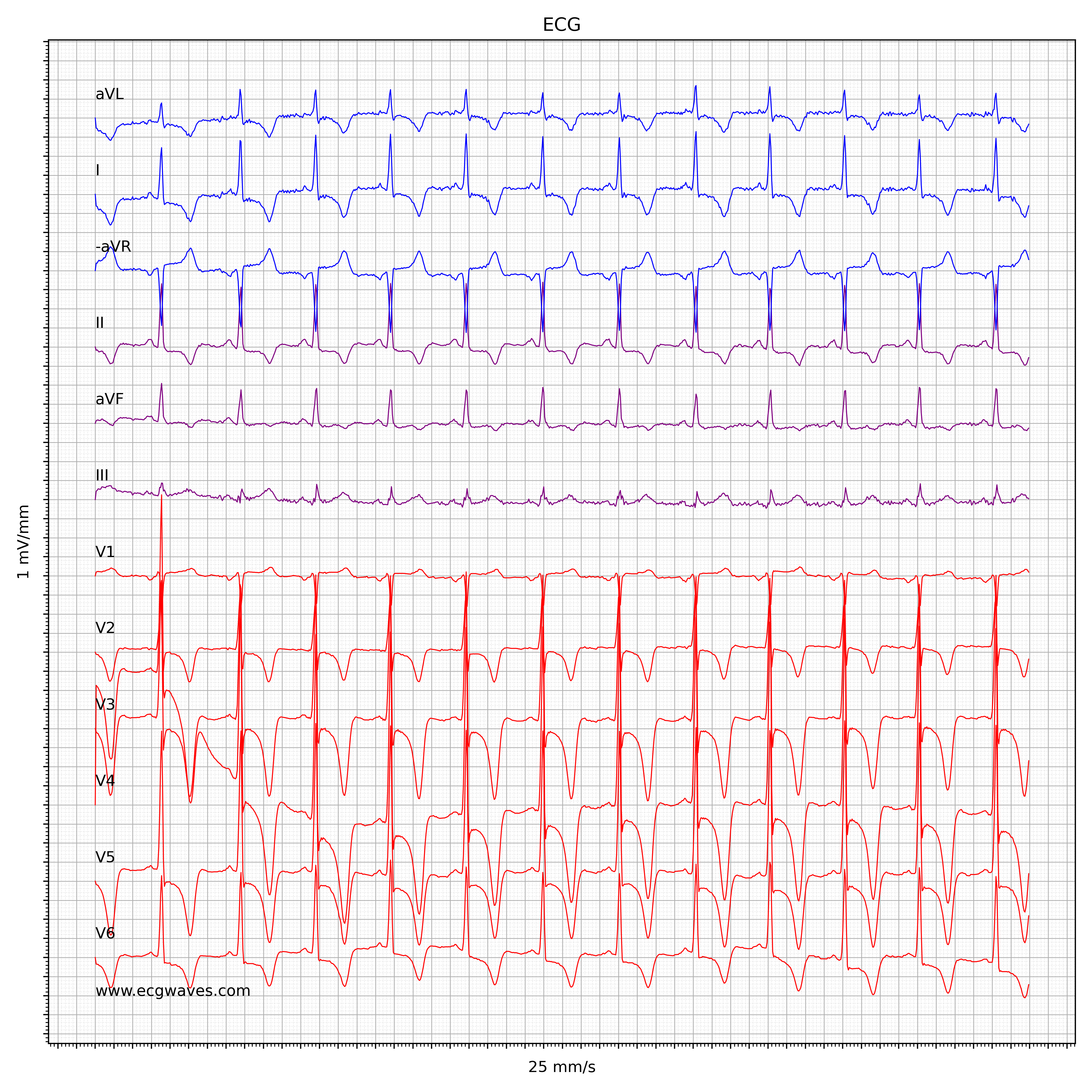 EKG bei hypertropher obstruktiver Kardiomyopathie (HCM, HOCM)