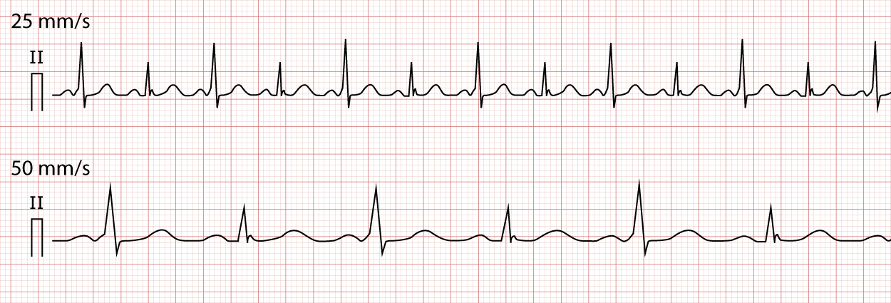 Abbildung 6. EKG, in dem ausnahmslos jeder Schlag über eine akzessorische Leitungsbahn übergeleitet wird, wodurch die QRS-Amplitude variiert.