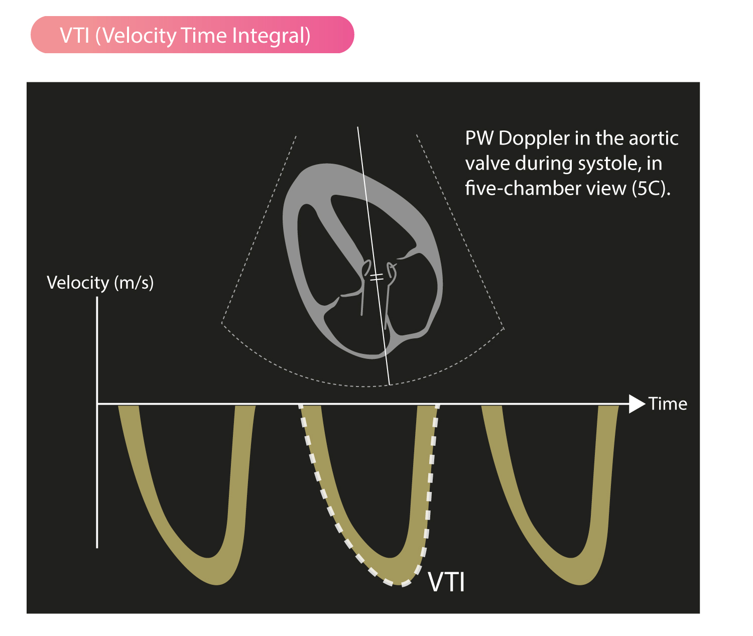 Abbildung 2. VTI (Velocity Time Integral). Pulsed-Wave-Doppler in der Aortenklappe während des Systole (Fünfkammerblick).