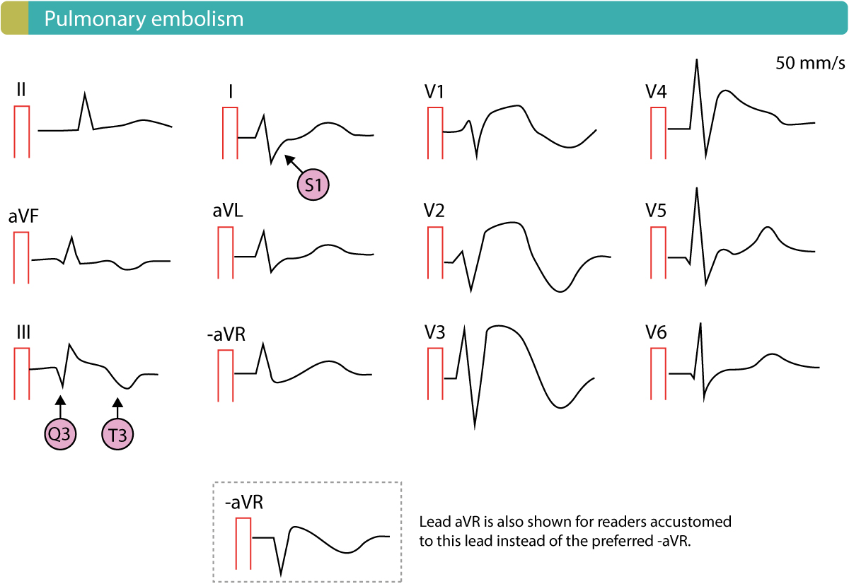 EKG bei Lungenembolie mit S1Q3T3-Muster und Rechtsschenkelblock