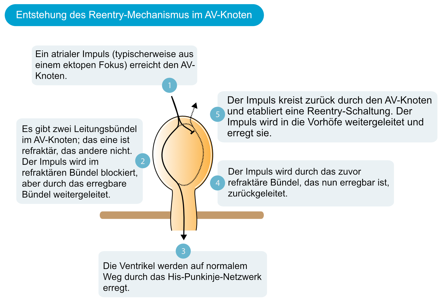 Abbildung 1. Mechanismus, der zu einer AV-Knoten-Reentrytachykardie führt.