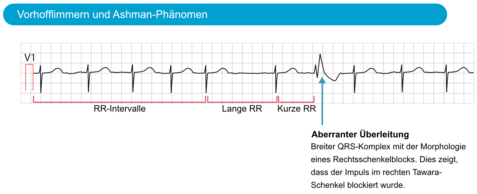 Abbildung 4. Das EKG zeigt ein Ashman-Phänomen bei Vorhofflimmern.