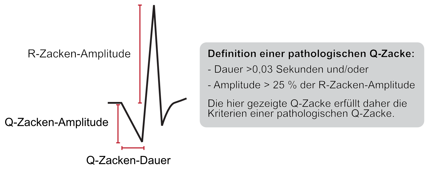 Abbildung 11. Kriterien für pathologische Q-Zacken.