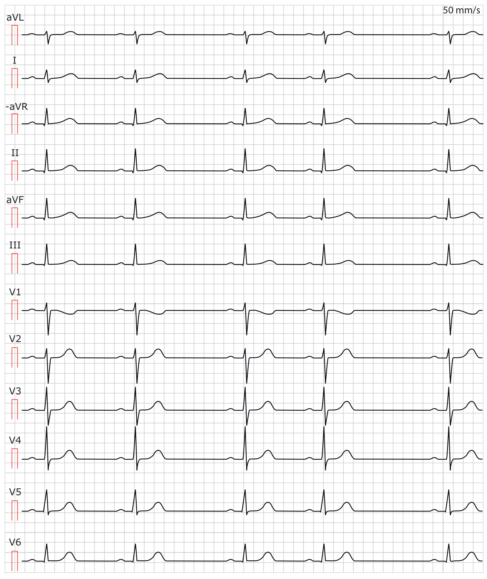 Abbildung 1. Sinusarrhythmie (Respiratorische Sinusarrhythmie).