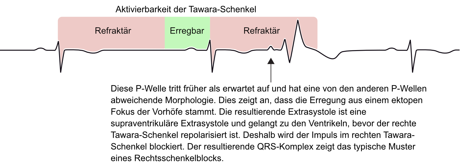 Abbildung 1. Die Abbildung zeigt eine supraventrikuläre Extrasystole (d. h. einen vorzeitigen Vorhofkomplex/-schlag), die mit aberranter Überleitung auftritt. Der supraventrikuläre Impuls erreicht das His-Purkinje-System, während der rechte Tawara-Schenkel noch refraktär ist und daher den Impuls blockiert. Der resultierende QRS-Komplex hat die Morphologie eines Rechtsschenkelblocks (rSR-Muster), was auf eine aberrante Überleitung zurückzuführen ist.