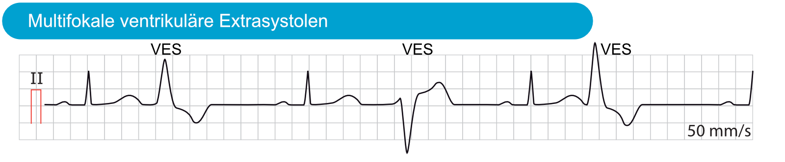 Abbildung 5. Multifokale ventrikuläre Extrasystolen. Diese ventrikulären Extrasystolen haben sowohl eine variierende Morphologie als auch ein variierendes zeitliches Auftreten im EKG. Sie stammen daher aus unterschiedlichen ektopen Fokussen.