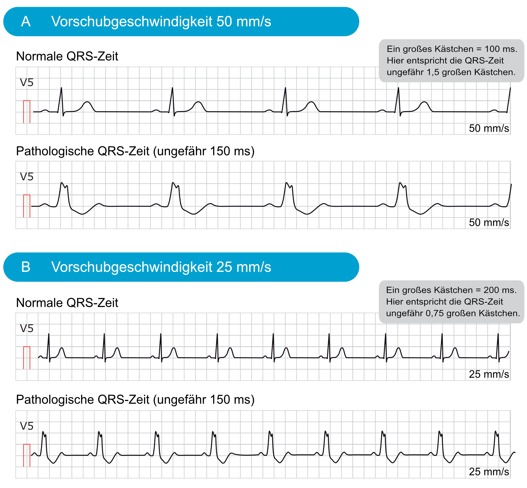 Abbildung 8. Normale und pathologische QRS-Zeiten bei unterschiedlichen Papiervorschubgeschwindigkeiten.