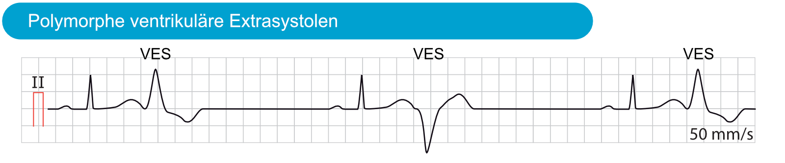 Abbildung 4. Polymorphe ventrikuläre Extrasystolen. Polymorphe ventrikuläre Extrasystolen zeichnen sich durch eine variierende QRS-Morphologie aus, weisen aber ein konstantes zeitliches Auftreten auf. Diese ektopen Schläge stammen aus demselben ektopen Fokus, aber die Impulse werden von Schlag zu Schlag unterschiedlich weitergeleitet.
