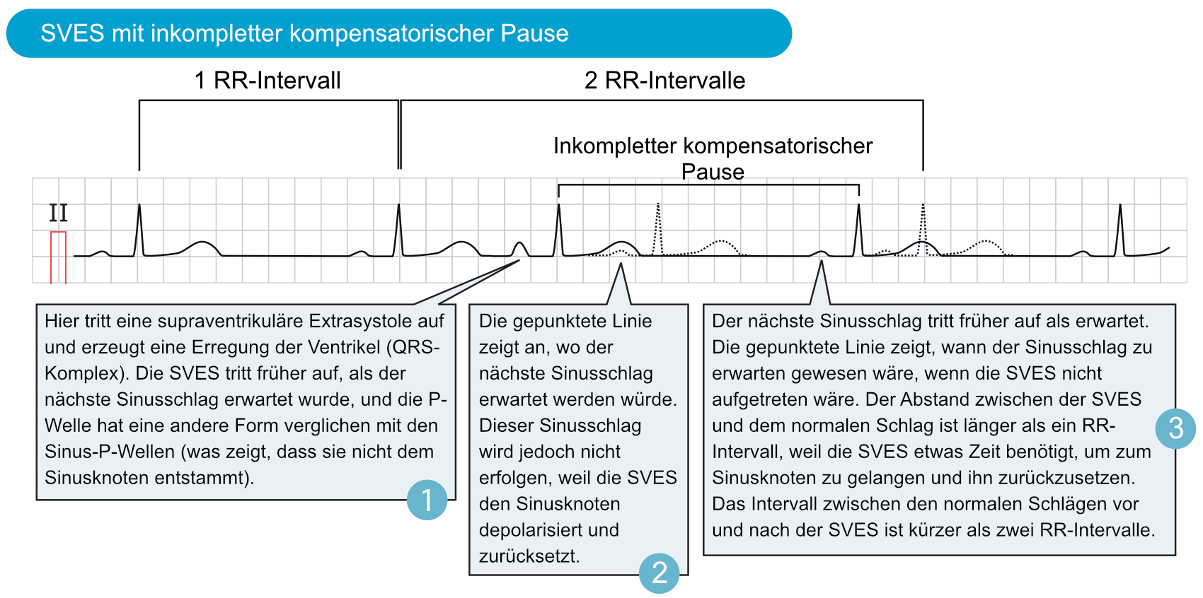 Abbildung 4. Supraventrikuläre Extrasystole (SVES) mit inkompletter kompensatorischer Pause.