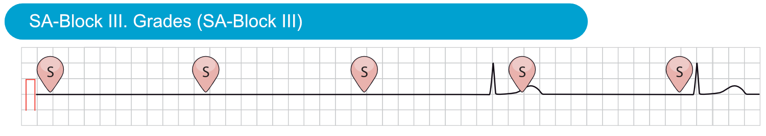 Abbildung 4. SA-Block III. Grades. Es werden keine Sinusimpulse zu den Vorhöfen weitergeleitet. Bevor der vierte Sinusimpuls erzeugt wird, manifestiert sich ein junktionaler Ersatzrhythmus. Dies ist an der normalen Dauer des QRS-Komplexes (was den supraventrikulären Ursprung anzeigt) und an der fehlenden P-Welle vor dem QRS-Komplex erkennbar.