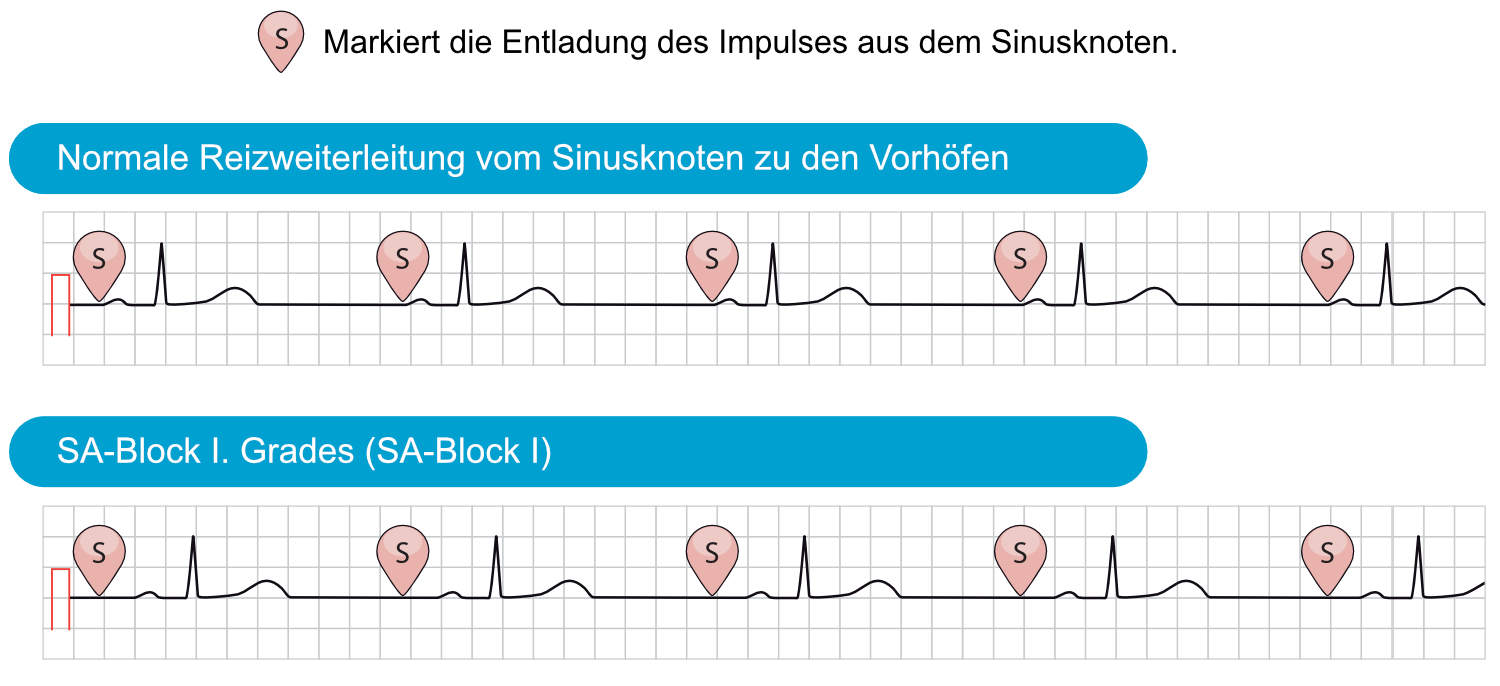 Abbildung 1. Das obere EKG zeigt eine normale Reizweiterleitung vom Sinusknoten zu den Vorhöfen. Die Vorhofdepolarisation beginnt fast unmittelbar nach der Entladung des Impulses im Sinusknoten. Das untere EKG zeigt einen SA-Block I. Grades, bei dem das Zeitintervall von der Impulsentladung zur Vorhofdepolarisation verlängert ist, was im Oberflächen-EKG nicht erkennbar ist. Wie hier zu sehen, ist der Rhythmus immer noch regelmäßig und alle Komplexe erscheinen normal.