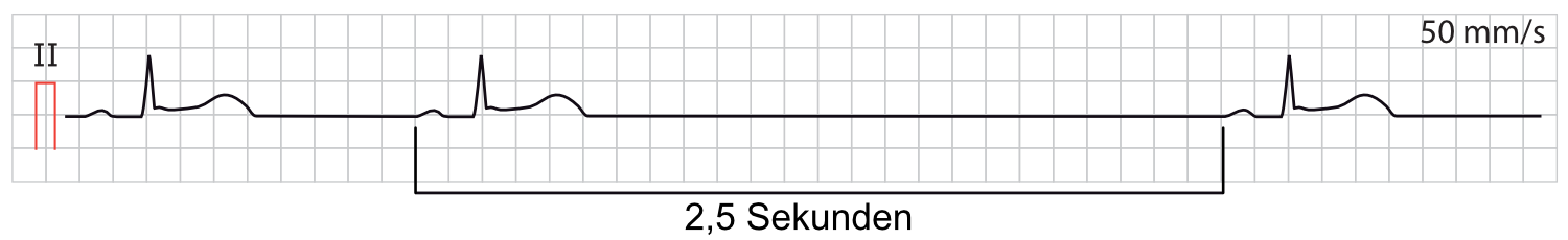 Abbildung 1. Sinusarrest.