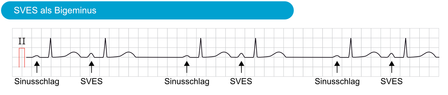 Abbildung 6. Supraventrikuläre Extrasystolen (SVES) als Bigeminus.