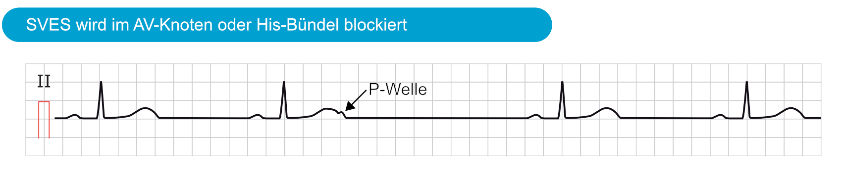 Abbildung 5. Eine supraventrikuläre Extrasystole (SVES) wird im AV-Knoten oder His-Bündel blockiert. Eine vermutliche P-Welle auf dem letzten Abschnitt der T-Welle. Die supraventrikuläre Extrasystole wird nicht weitergeleitet (es folgt kein QRS-Komplex), weil das atrioventrikuläre Reizleitungssystem in dieser frühen Phase des Herzzyklus