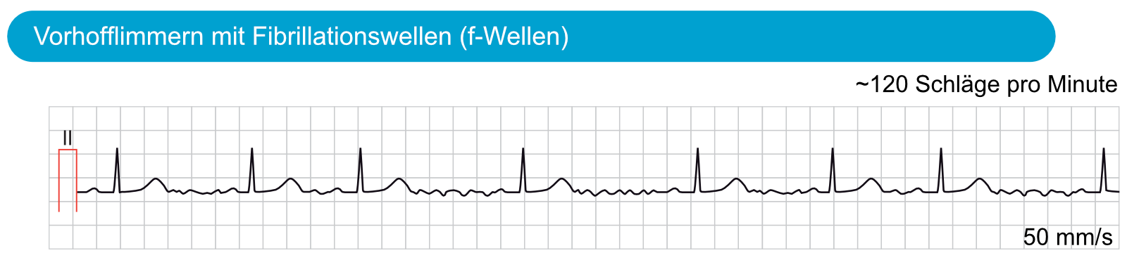 Abbildung 1. Vorhofflimmern mit Fibrillationswellen (f-Wellen). f-Wellen haben eine variierende Morphologie und eine unregelmäßige Frequenz zwischen 300 und 600 pro Minute.