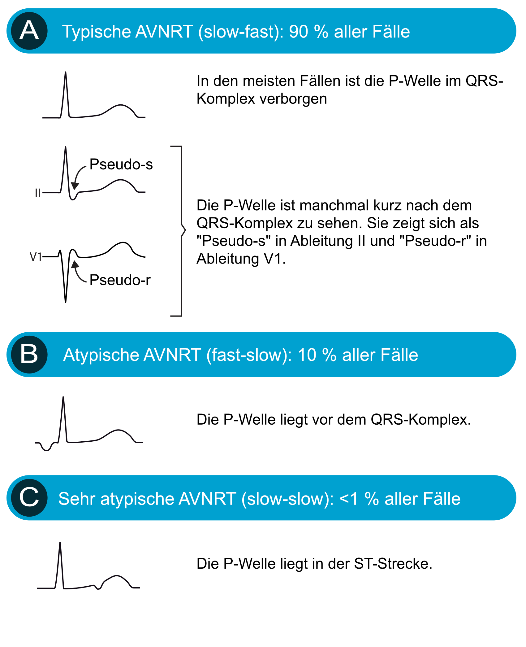 Abbildung 2. Arten der AV-Knoten-Reentrytachykardie.
